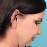 Facelift Before & After Patient #4656