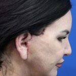 Facelift Before & After Patient #4656