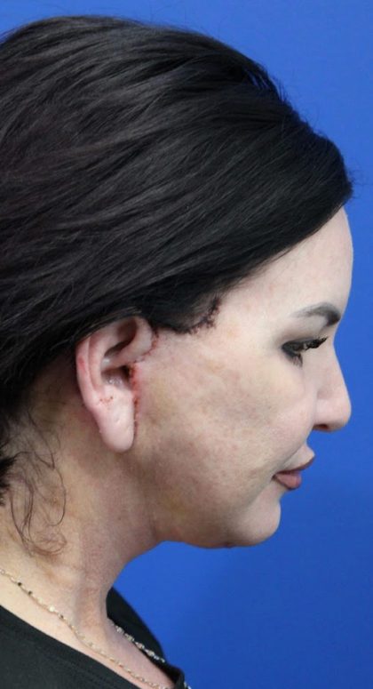 Facelift Before & After Patient #4656