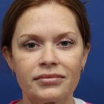 Facelift Before & After Patient #4657