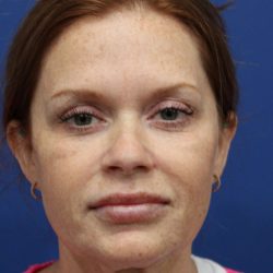 Facelift Before & After Patient #4657