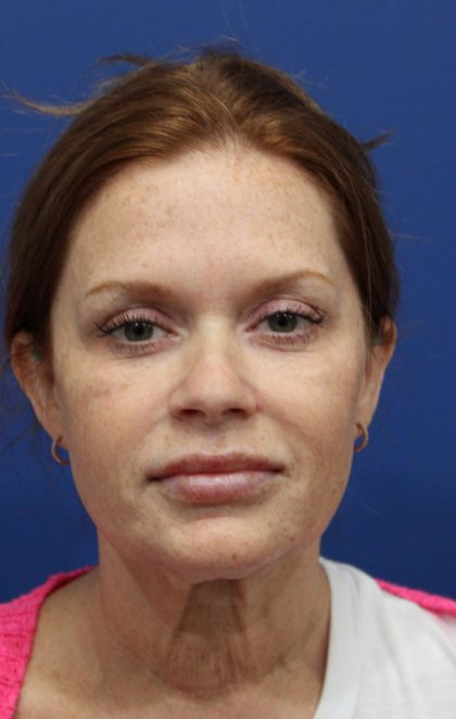 Facelift Before & After Patient #4657