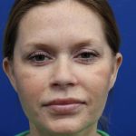 Facelift Before & After Patient #4657
