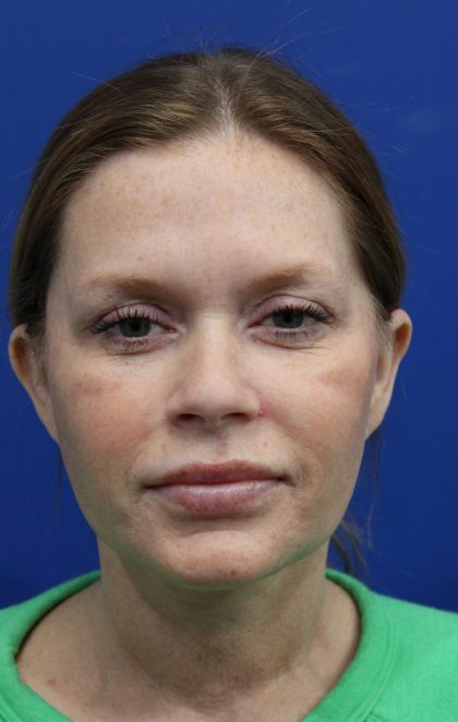 Facelift Before & After Patient #4657