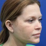 Facelift Before & After Patient #4657