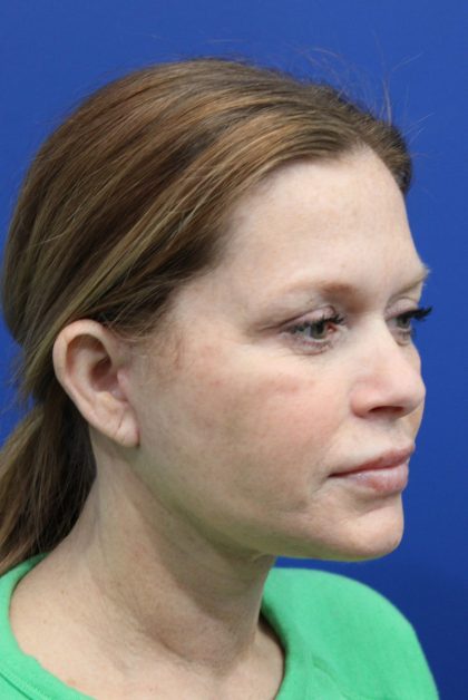 Facelift Before & After Patient #4657