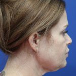 Facelift Before & After Patient #4657