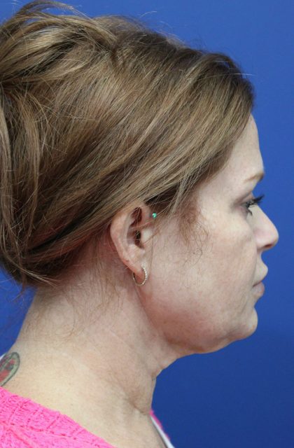 Facelift Before & After Patient #4657