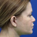 Facelift Before & After Patient #4657