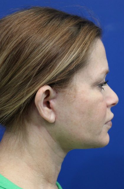 Facelift Before & After Patient #4657