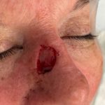 Mohs Surgery Before & After Patient #4658