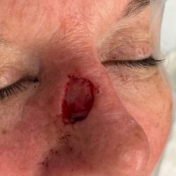 Mohs Surgery Before & After Patient #4658