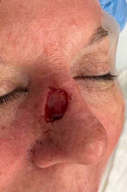 Mohs Surgery Before & After Patient #4658
