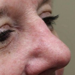Mohs Surgery Before & After Patient #4658