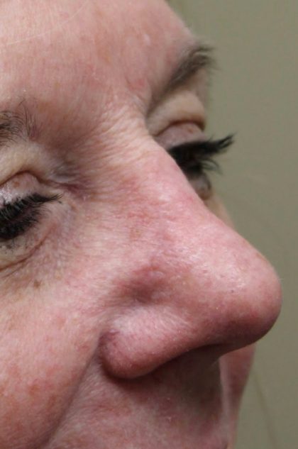 Mohs Surgery Before & After Patient #4658