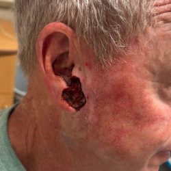 Mohs Surgery Before & After Patient #4659