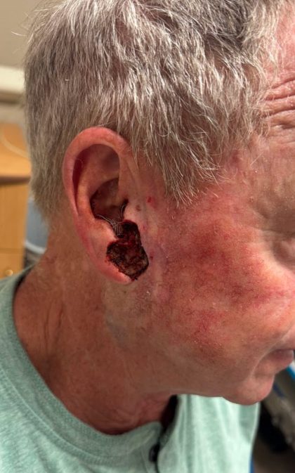 Mohs Surgery Before & After Patient #4659