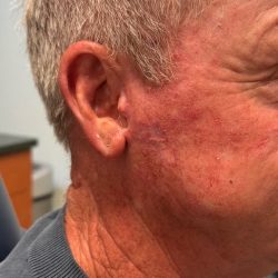 Mohs Surgery Before & After Patient #4659