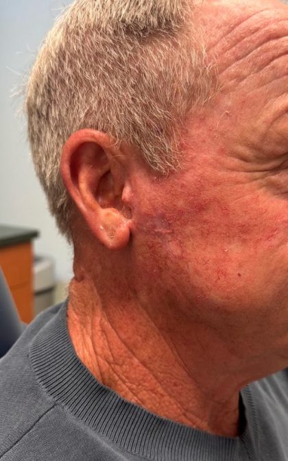 Mohs Surgery Before & After Patient #4659