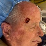 Mohs Surgery Before & After Patient #4660