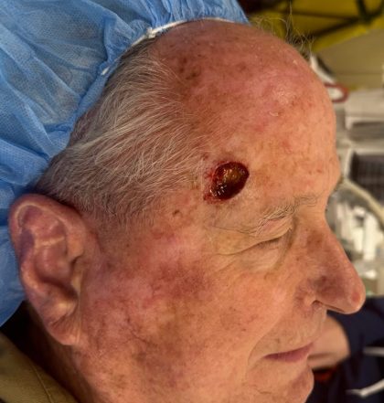 Mohs Surgery Before & After Patient #4660