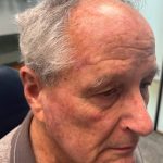 Mohs Surgery Before & After Patient #4660