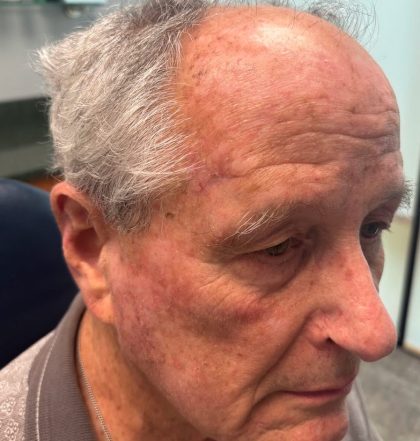 Mohs Surgery Before & After Patient #4660