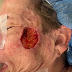 Mohs Surgery Before & After Patient #4661