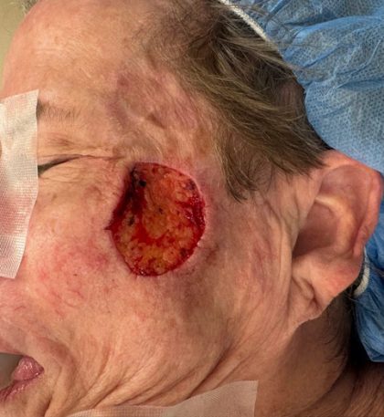 Mohs Surgery Before & After Patient #4661