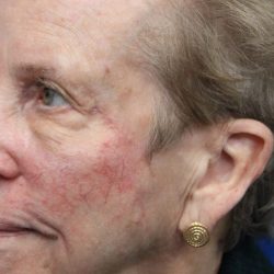 Mohs Surgery Before & After Patient #4661