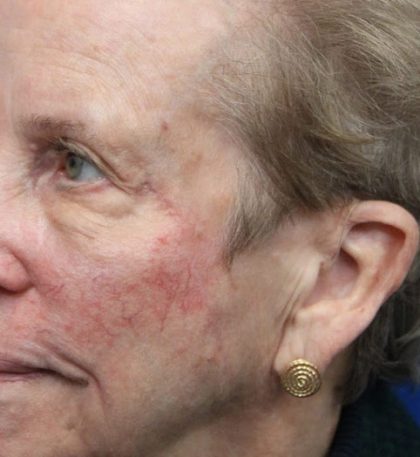 Mohs Surgery Before & After Patient #4661