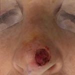 Mohs Surgery Before & After Patient #4662