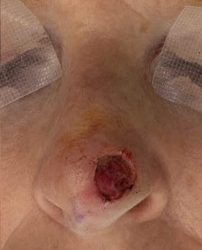 Mohs Surgery Before & After Patient #4662