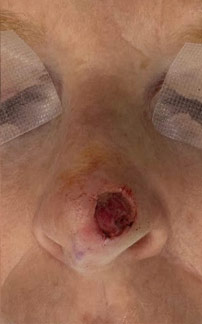 Mohs Surgery Before & After Patient #4662