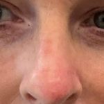 Mohs Surgery Before & After Patient #4662