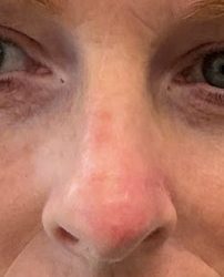 Mohs Surgery Before & After Patient #4662