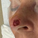 Mohs Surgery Before & After Patient #4662