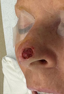 Mohs Surgery Before & After Patient #4662