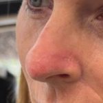Mohs Surgery Before & After Patient #4662