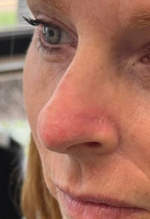 Mohs Surgery Before & After Patient #4662