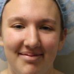 Rhinoplasty Before & After Patient #4666