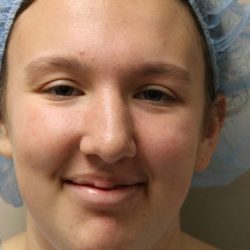 Rhinoplasty Before & After Patient #4666