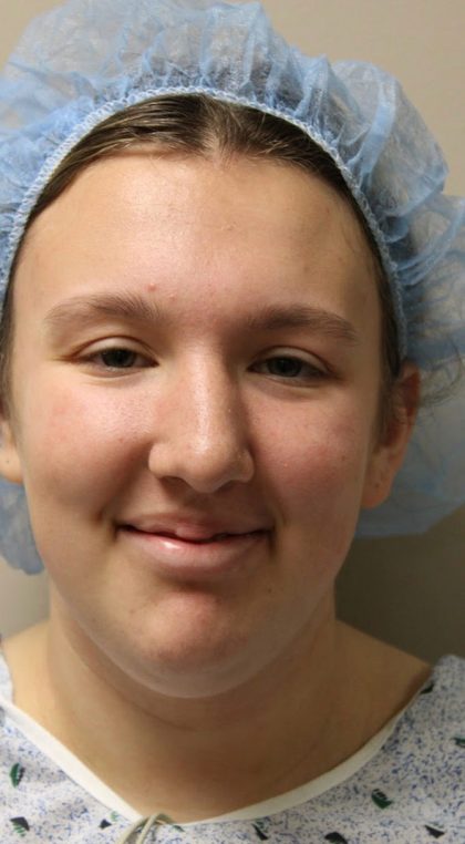 Rhinoplasty Before & After Patient #4666