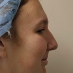 Rhinoplasty Before & After Patient #4666
