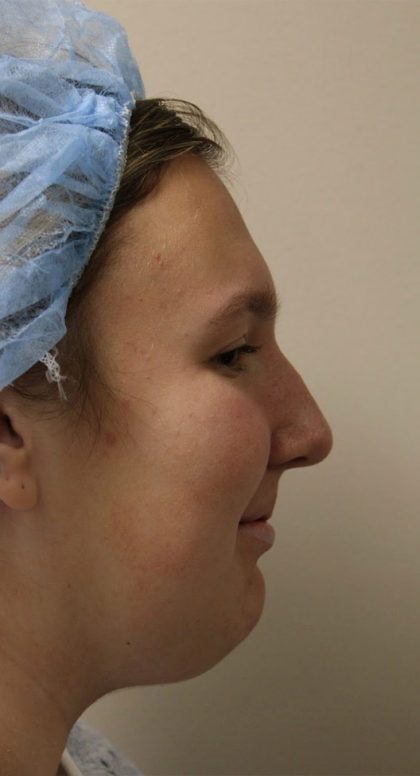 Rhinoplasty Before & After Patient #4666