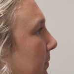 Rhinoplasty Before & After Patient #4666