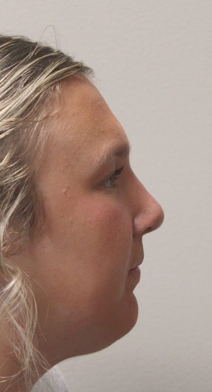 Rhinoplasty Before & After Patient #4666