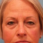 Upper Blepharoplasty Before & After Patient #4667