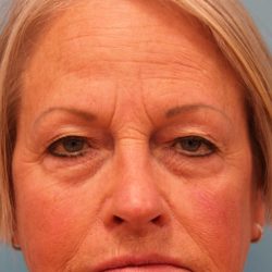 Upper Blepharoplasty Before & After Patient #4667