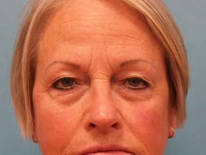 Upper Blepharoplasty Before & After Patient #4667